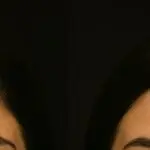 بوتوكس